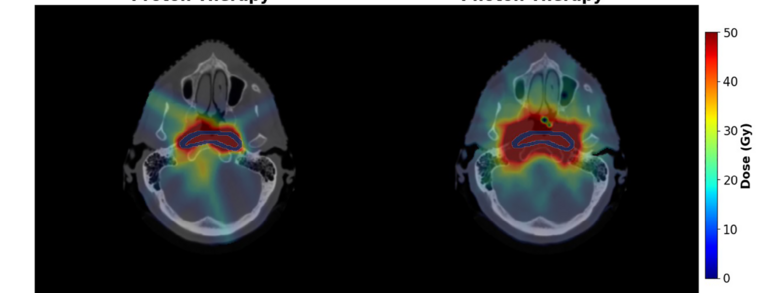 dose distribution in patient: comparison between proton photon therapy