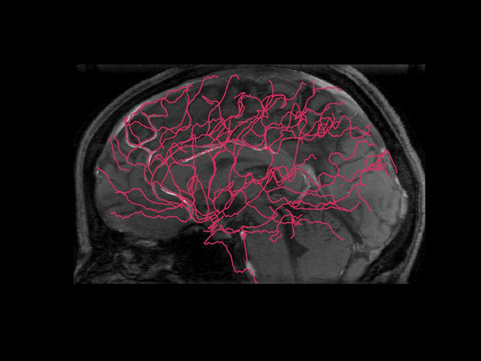 Brain scan based on MRI and cerebrovasculature