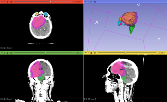 Brain tumor from a CT scan